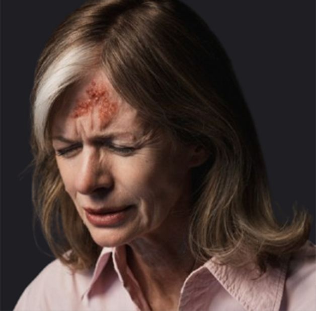 מהי שלבקת חוגרת?